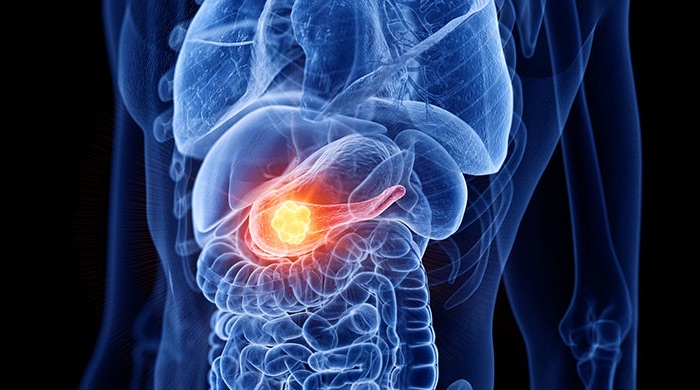 Tumore al pancreas: passi avanti sperimentali nella terapia